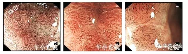 胃小灶癌变,胃体小凹型腺瘤