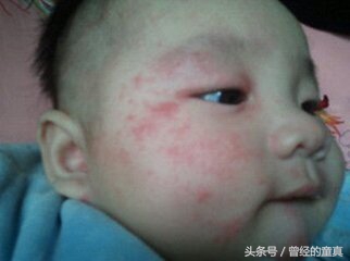 怎么预防宝宝奶癣复发,婴儿奶癣有什么办法解决