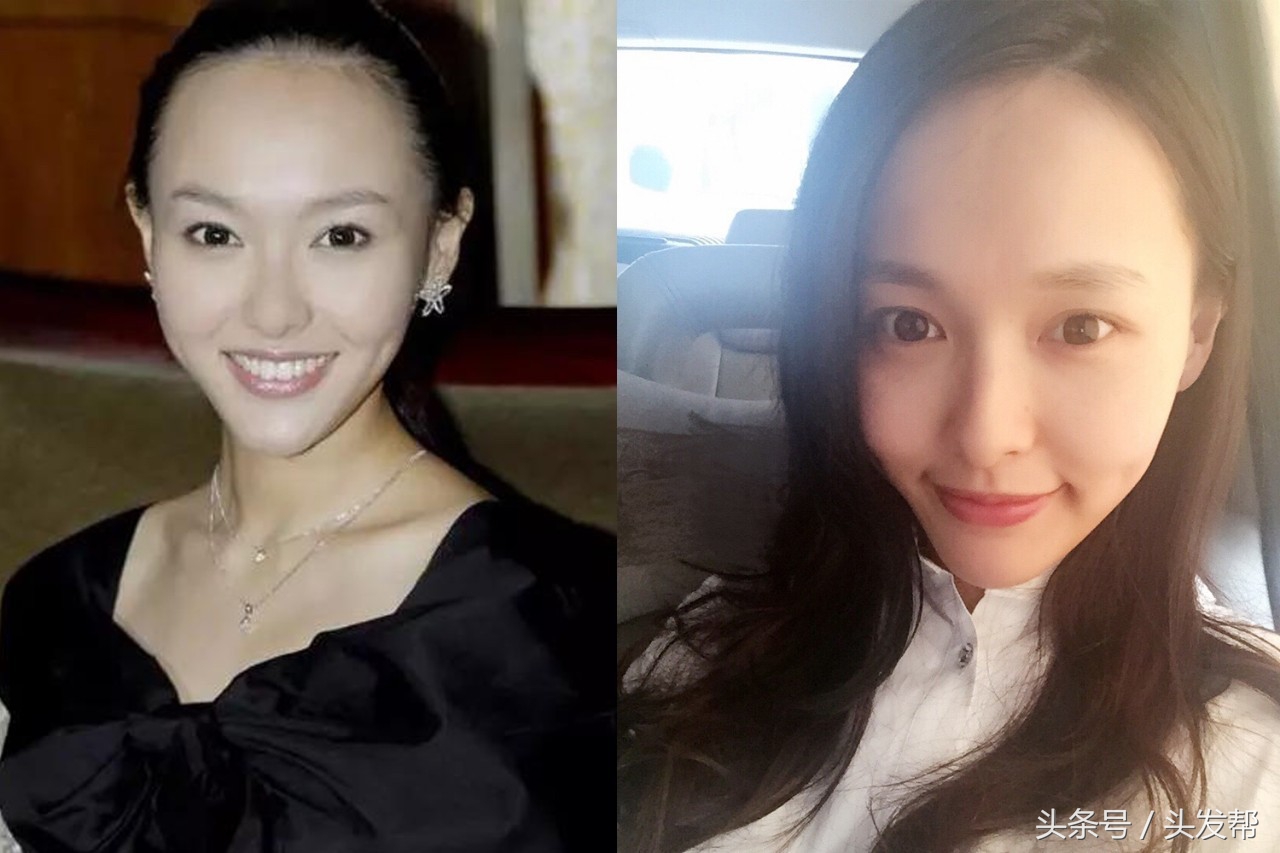 发际线高显老怎么办,发际线高方圆脸怎么办