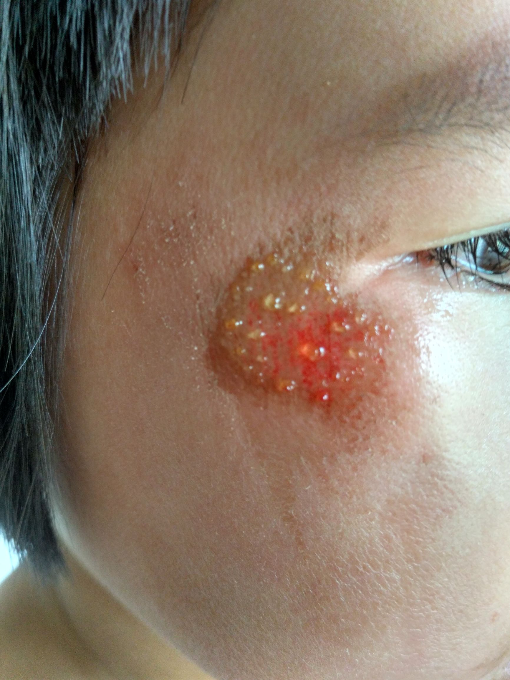 女儿脸被摔很自责,小孩脸摔破了怎么处理