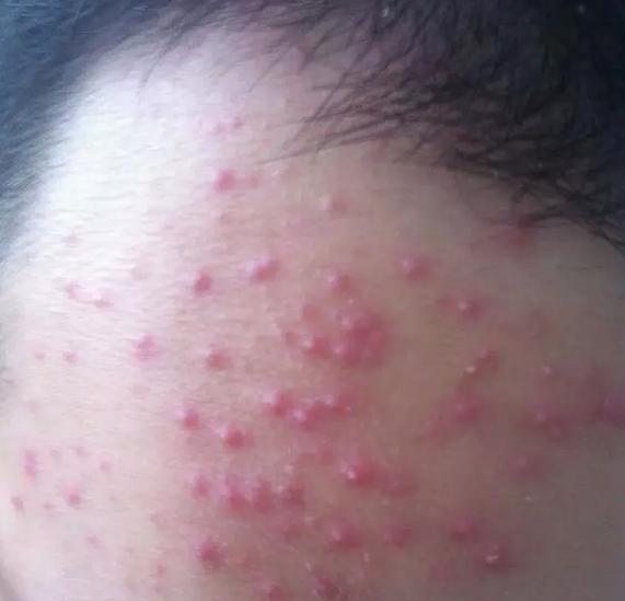 消了又长的疮是什么疮,脸部长疮的症状和治疗方法