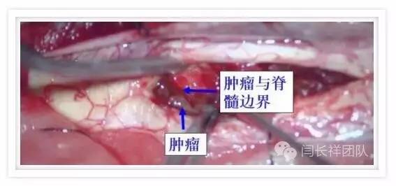 闫长祥脑膜瘤,闫长祥能治愈弥漫中线胶质瘤吗