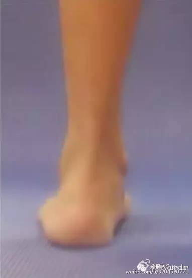 扁平足的矫正方法,2岁扁平足需要矫正么