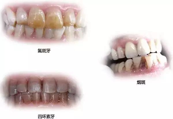 牙齿黄又丑又尴尬,牙齿黄笑的难看怎么办