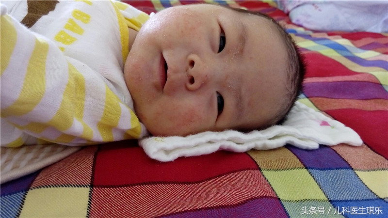 康复新液可以治疗湿疹吗,湿疹感染溃烂可以用康复新液吗