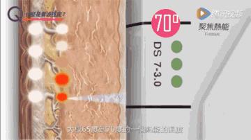 做完超声刀起红点是为什么,脖子做超声刀术后保养