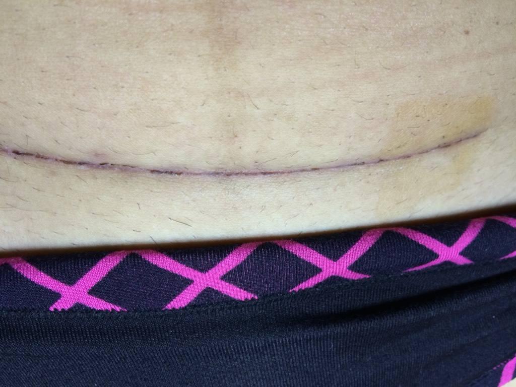 顺产和剖腹产对孕妇哪个好一些,顺产和剖腹产对孕妈哪个好一些