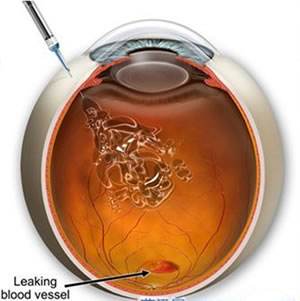 遗传性黄斑病变基因治疗突破,基因疗法能治黄斑病吗