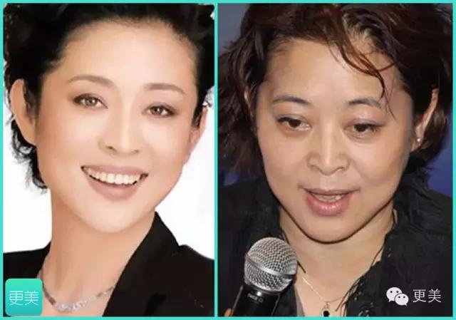 青春定格？4D埋线？音波拉皮？别晕，面部提升就那老三样