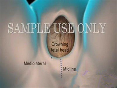 动画演示宝宝分娩侧切过程,产妇分娩侧切