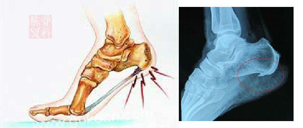 孙思邈怎么治疗骨质增生,孙思邈治骨刺秘方