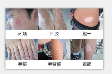 白癜风诊断及鉴别诊断,白癜风的鉴别与诊断