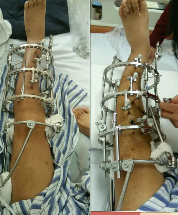 o型腿怎么矫正变直,o型腿矫正十种让腿变直的方法