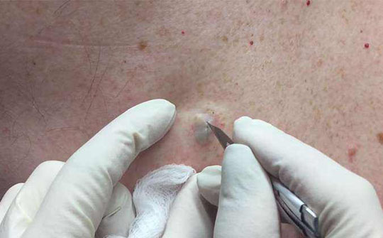 推背后长痘是怎么回事,背后长脓包痘怎么解决