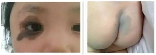 初生婴儿痣和胎记怎么区别,孩子长痣和胎记区别