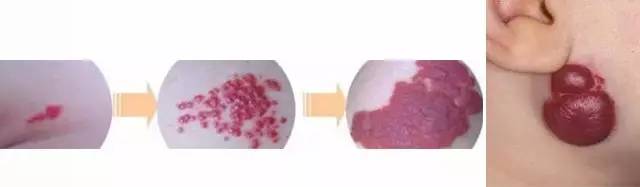 初生婴儿痣和胎记怎么区别,孩子长痣和胎记区别