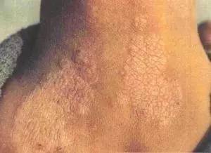 神经性皮炎治好后皮肤能恢复吗,神经性皮炎用冷冻疗法是否能治好