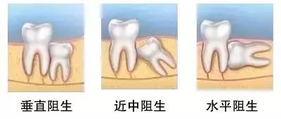 医生拔智齿,去医院拔智齿需要多少时间