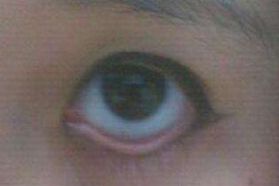 上眼睑轻微外翻有办法治疗吗,眼睑外翻治疗方案