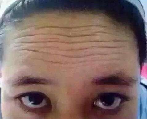 6个小窍门巧妙去除抬头纹,从小就有抬头纹怎么消除简单方法