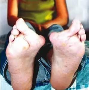 跑鞋导致拇外翻,拇外翻必须穿专门跑鞋跑步吗