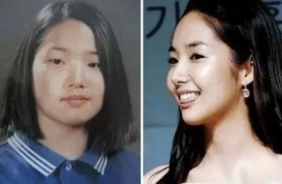 鼻子垫的太往上了,鼻子垫得不高是不是不容易歪