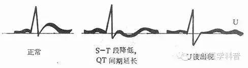 钾低是怎么回事,低钾是什么病