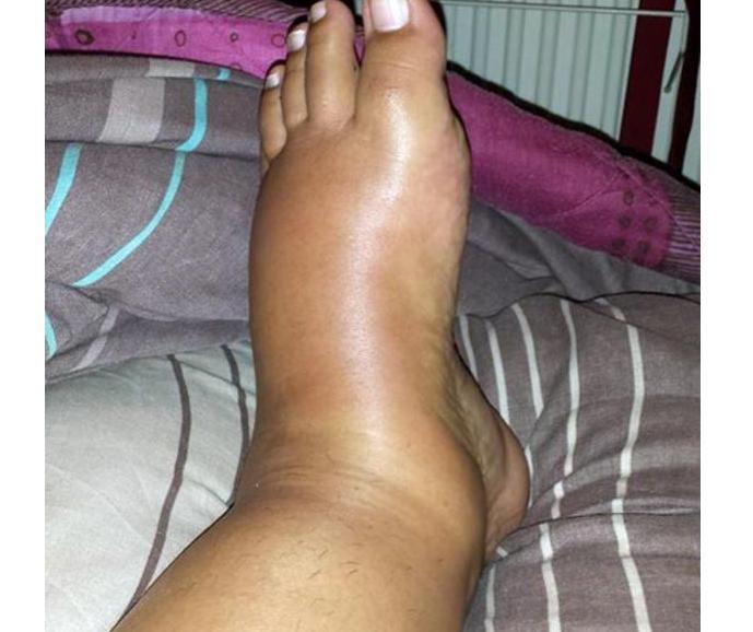 孕期妈妈预防水肿运动,准妈妈怎样避免孕期浮肿