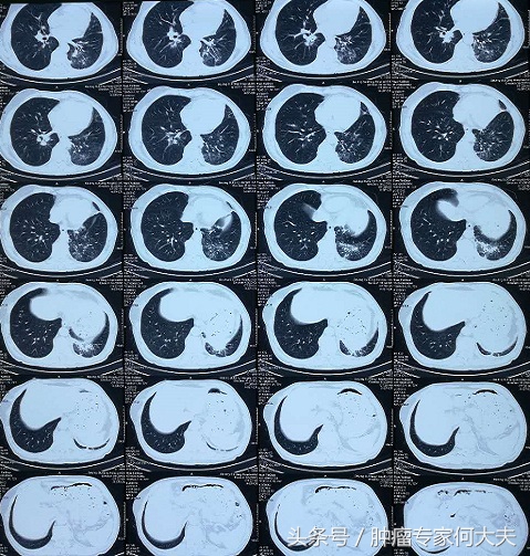 73岁老人得肺癌不治疗能活多久,77岁老人癌症晚期忽然喘不过气