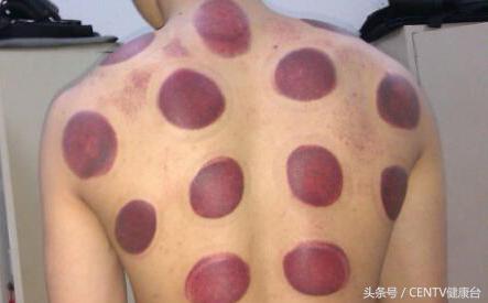 推完背拔完罐后背黑紫是什么原因,拔空气罐后皮肤黑紫原因