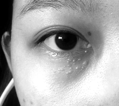 汗管瘤一旦长出很难自己好患者可用激光等治疗