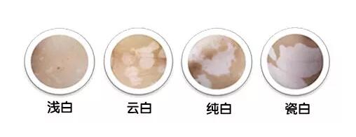 白癜风的四个初期症状,白癜风常见的20个问题