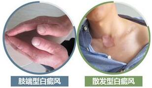 白癜风临床经典30问答