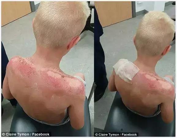 香蕉船防晒霜儿童可以用吗,香蕉船防晒霜用了脸刺痛