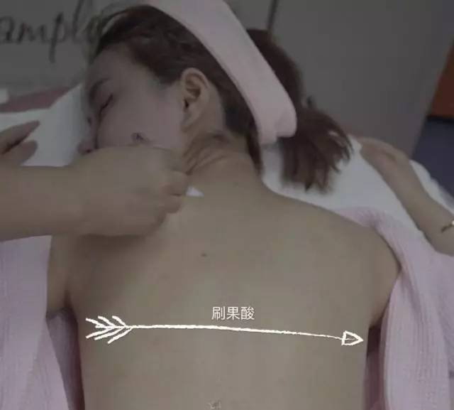 第二天要穿吊带如何解决背后痘痘,后背有痘痘穿吊带的急救办法