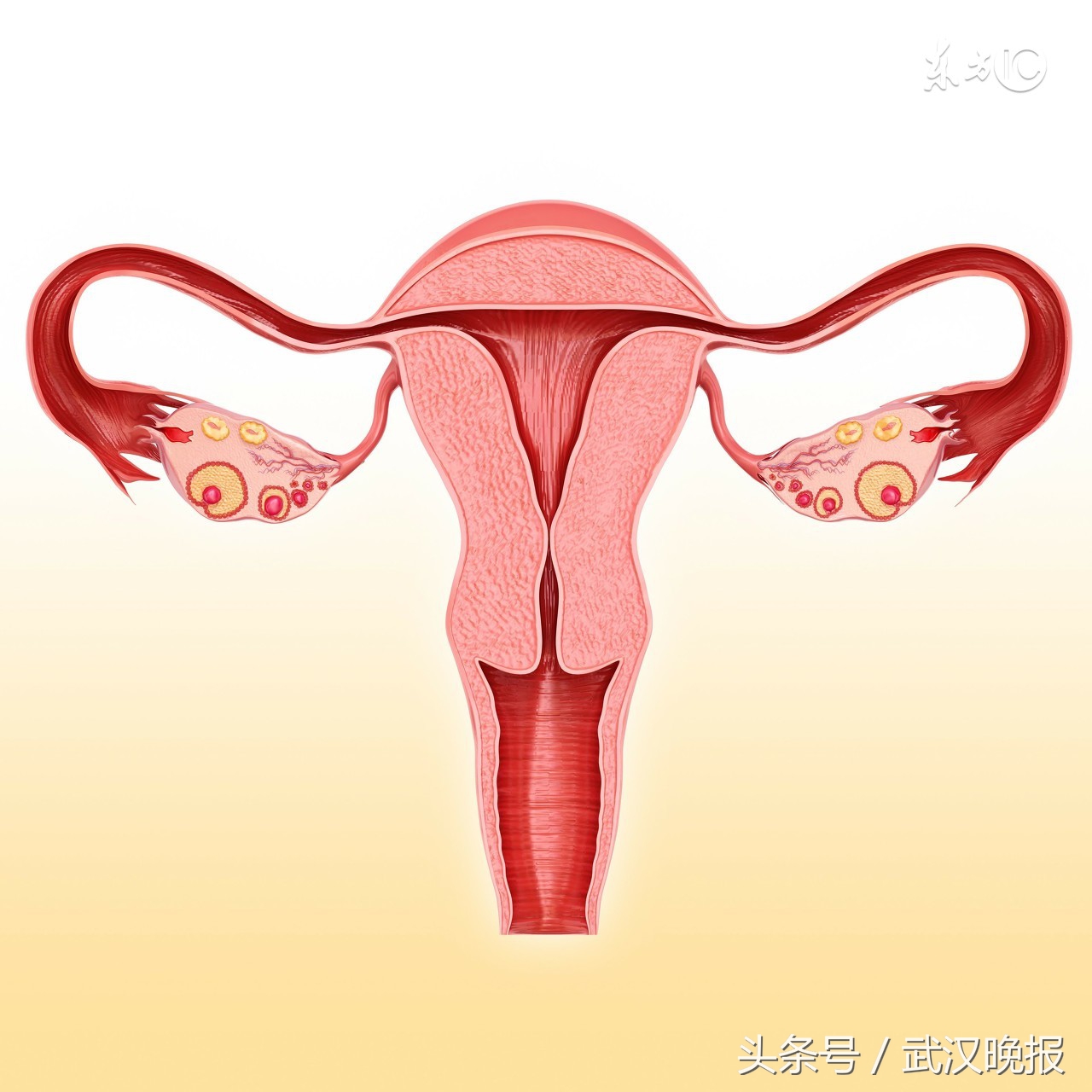 每次痛不欲生还发烧！新洲准新娘痛经12年婚检时发现“双子宫”！