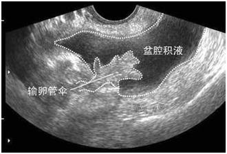 盆腔积液怎么回事,盆腔积水是怎么回事呢