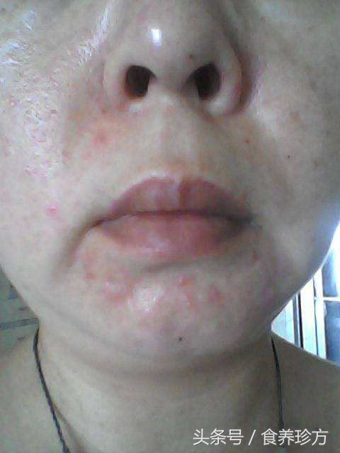 头湿气重症状,头湿气重