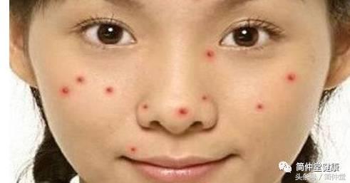 人中上长了个硬痘还疼,人中旁长痘预示着什么