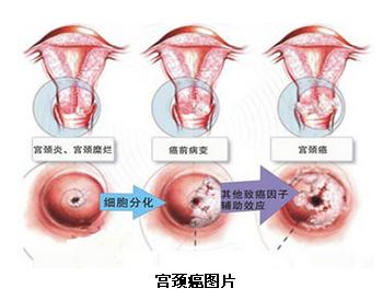 宫颈癌到底有没有报销的靶向药,宫颈癌到底有多痛苦