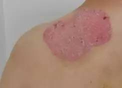 牛皮癣好了告别银屑病,华西看银屑病厉害的医生