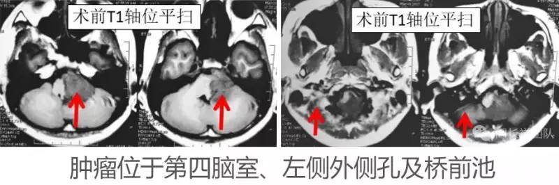 喝水容易呛是怎么回事是肺癌,老人喝水容易呛咳怎么办