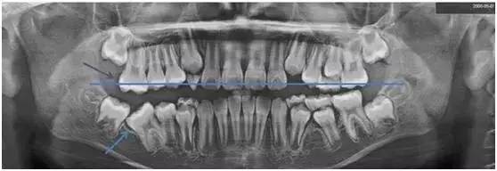 替牙期牙齿需要矫正吗,替牙期牙齿