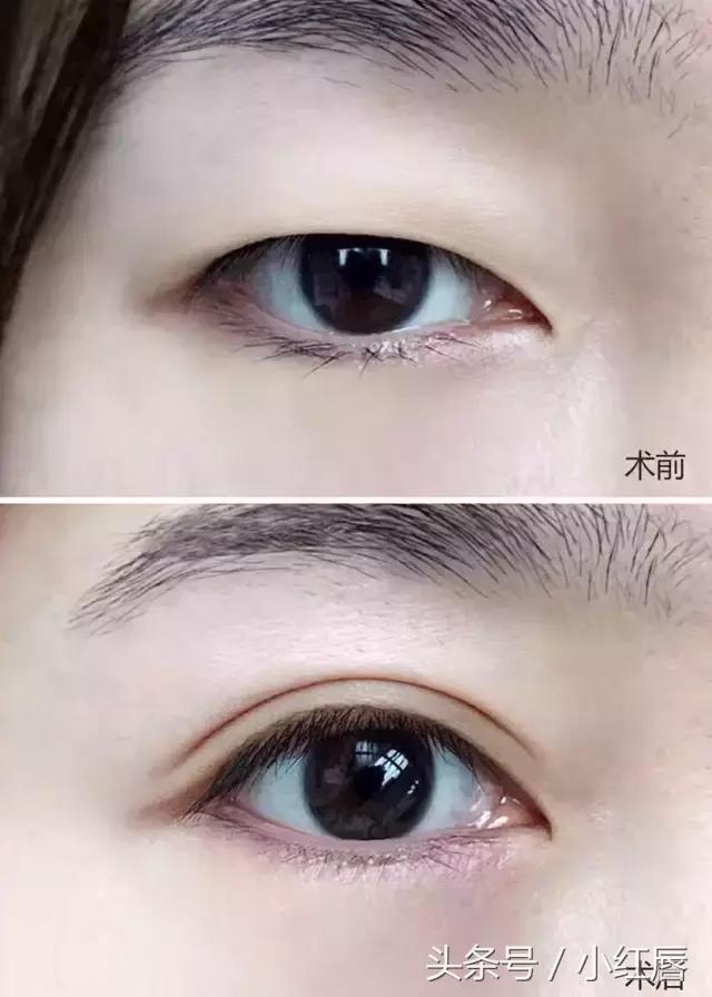 你的眼睛适合做什么手术,你的双眼皮什么时候做