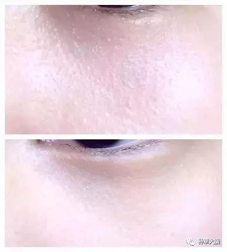为什么湿敷完全是闭口,去闭口湿敷多久一次为最佳
