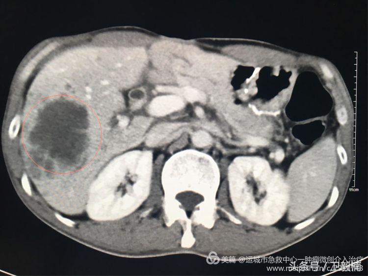肝脏转移瘤用介入治疗有效吗,肝转移肿瘤介入治疗