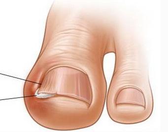 脚趾甲长肉里？不拔甲，1招帮你轻松治！