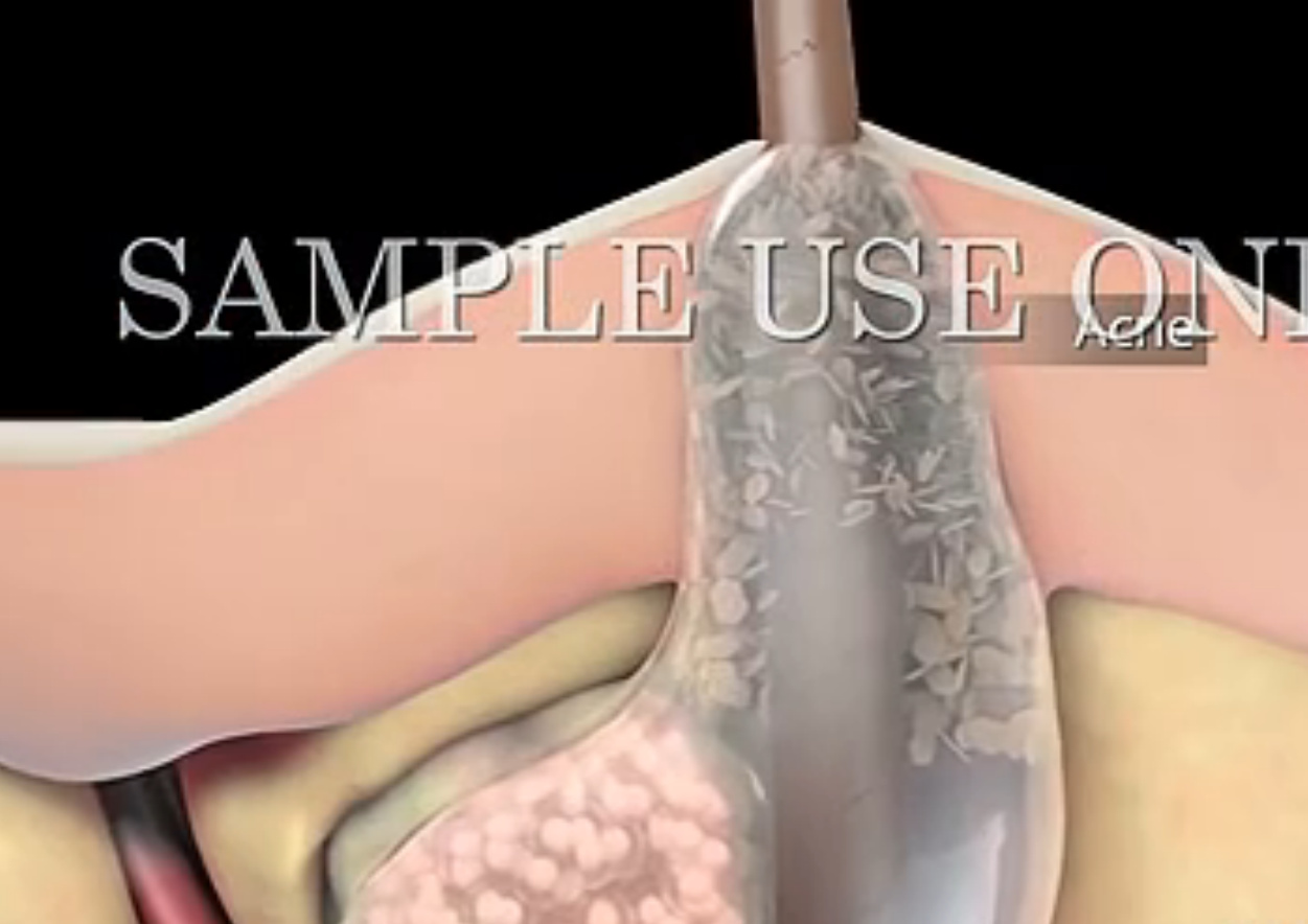 孩子长闭口粉刺怎么办,闭口粉刺总是长怎么办呢