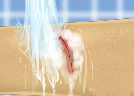 宝宝摔倒的伤疤怎样不留疤痕,宝宝摔倒怎么不留疤