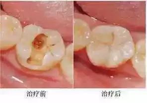 牙齿楔状缺损疼痛怎么办,儿童牙齿有缺损怎么治疗